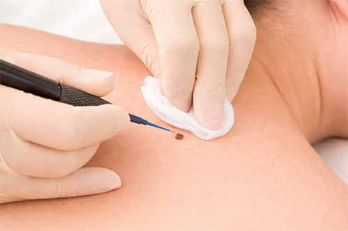 Skin tags