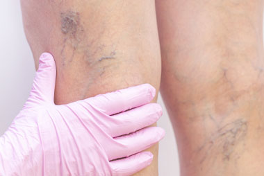 Vein removal treatment at Shemirani Beauty Clinic Thornhill ON