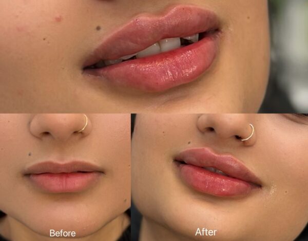 lip filler treatment at Shemirani Beauty Clinic Thornhill
