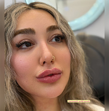 lip filler Thornhill | Shemirani