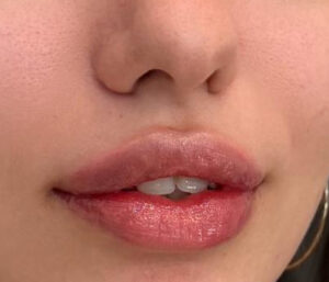 natural lip volume enhancement by Nurse Mina