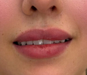 natural lip volume enhancement by Nurse Mina