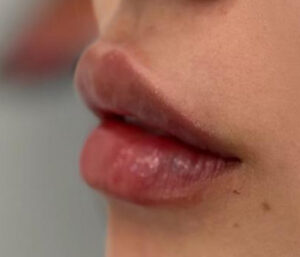 natural lip volume enhancement by Nurse Mina
