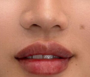 natural lip volume enhancement by Nurse Mina