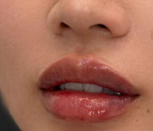 natural lip volume enhancement by Nurse Mina