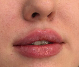 natural lip volume enhancement by Nurse Mina