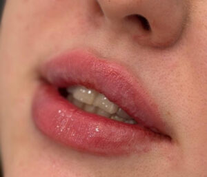 natural lip volume enhancement by Nurse Mina
