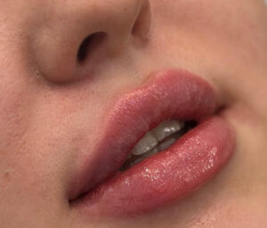 natural lip volume enhancement by Nurse Mina