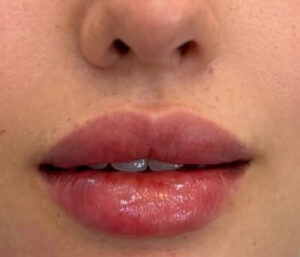 natural lip volume enhancement by Nurse Mina