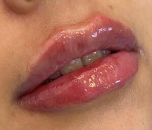 natural lip volume enhancement by Nurse Mina
