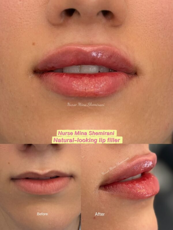 lip filler Thornhill | Shemirani