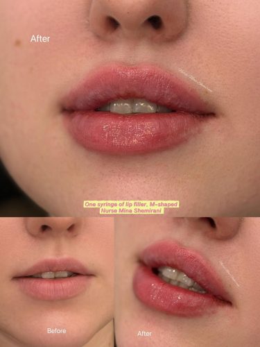 lip filler in Thornhill