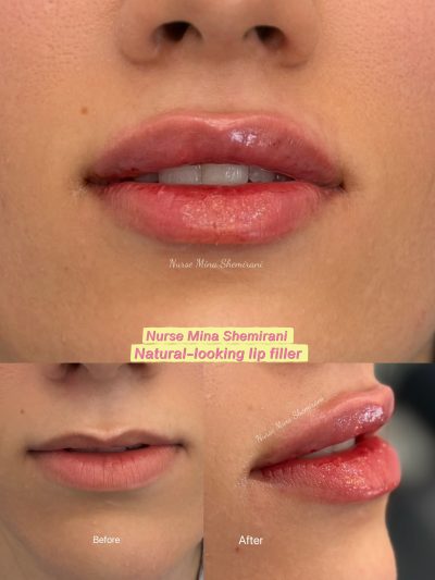 lip filler Thornhill | Shemirani