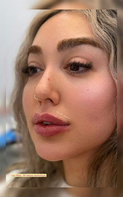 lip filler Thornhill